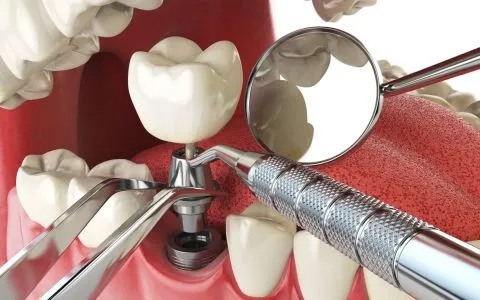 Implant dentar titan